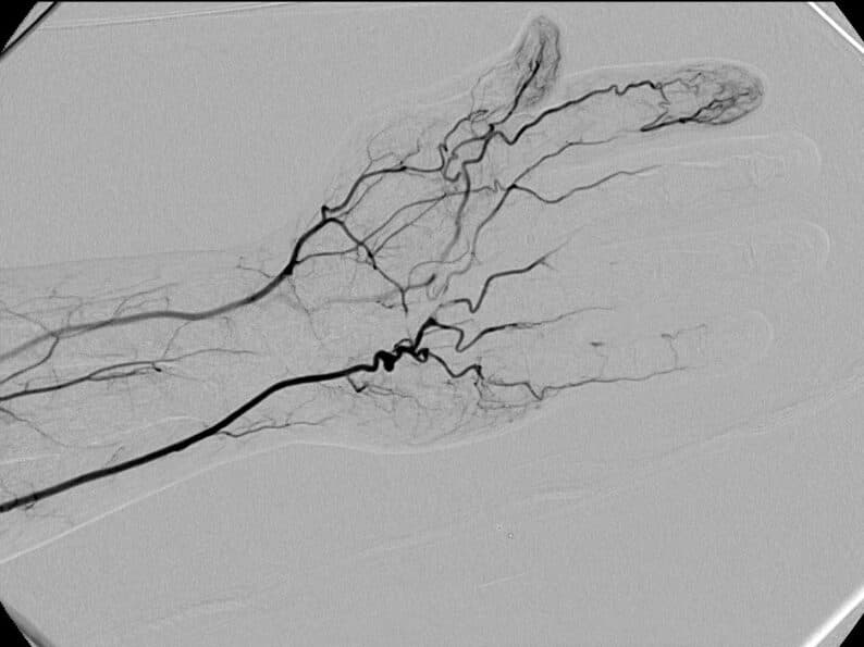 Hypothenar Hammer Syndrome case study